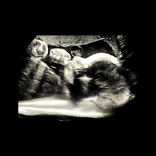 Arletta Samuel Baby Sonogram
